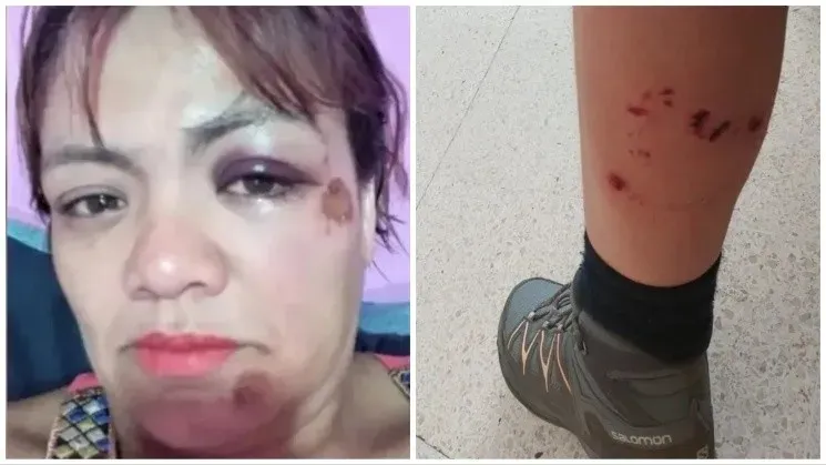 una_mujer_fue_atacada_ferozmente_por_una_jaurxa_mientras_paseaba_en_bicicleta_2.jpg_366287663